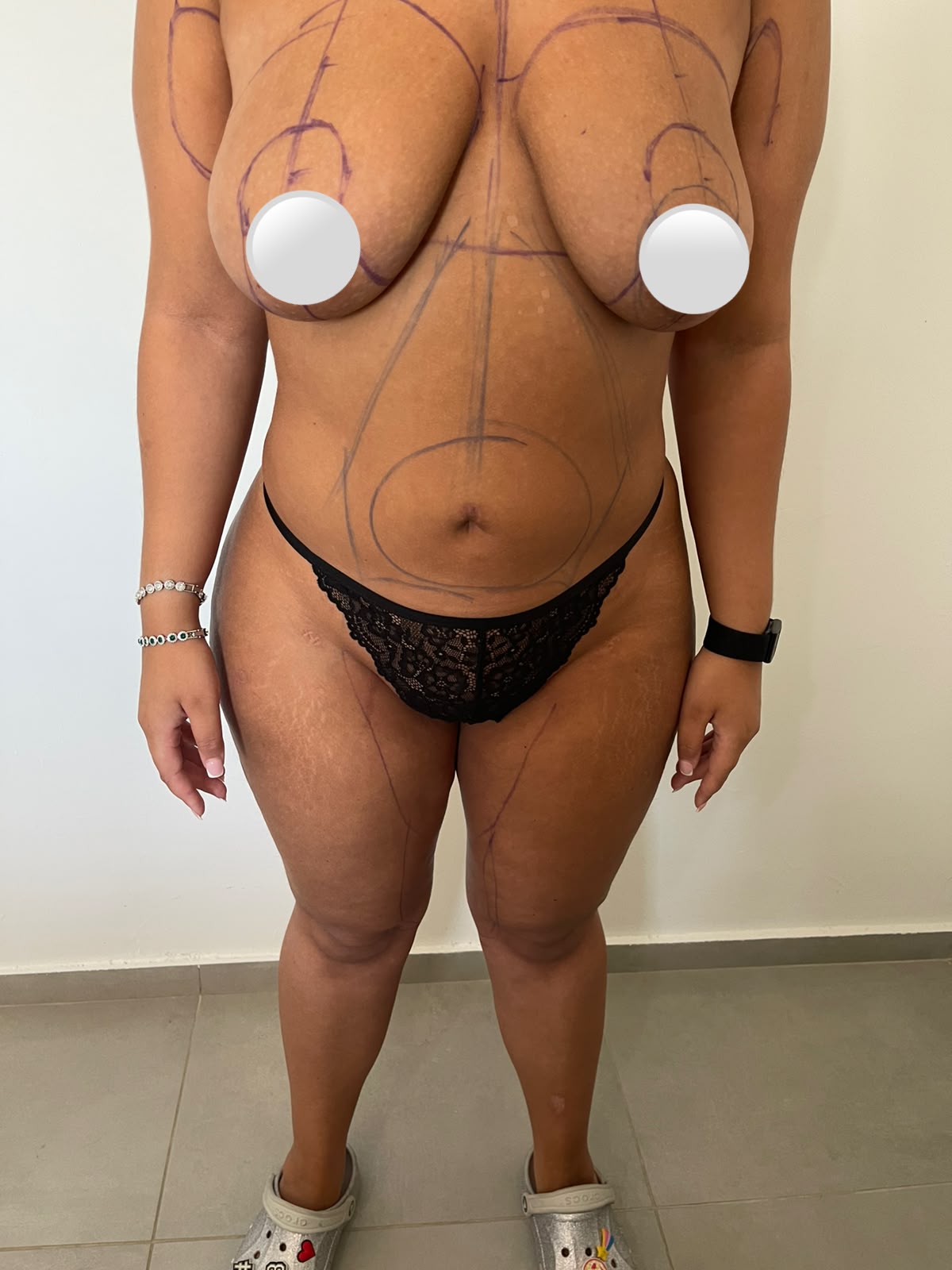 Avant — Liposuccion 360° + lifting des seins avec prothèses