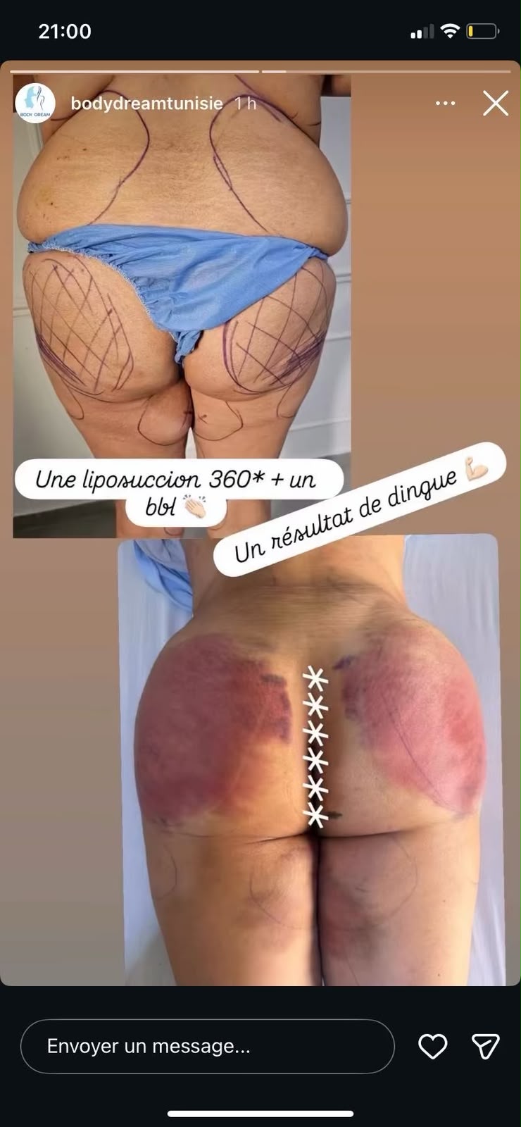 Résultat avant après — Liposuccion 360° + BBL